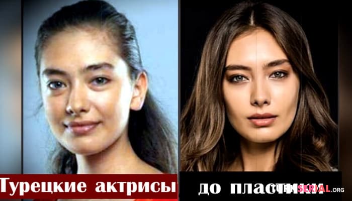 сериал Турецкие известные актрисы до и после пластики